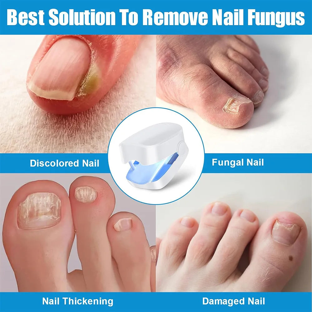 Dermoré™ – Pro Nail Fungus Laser Device